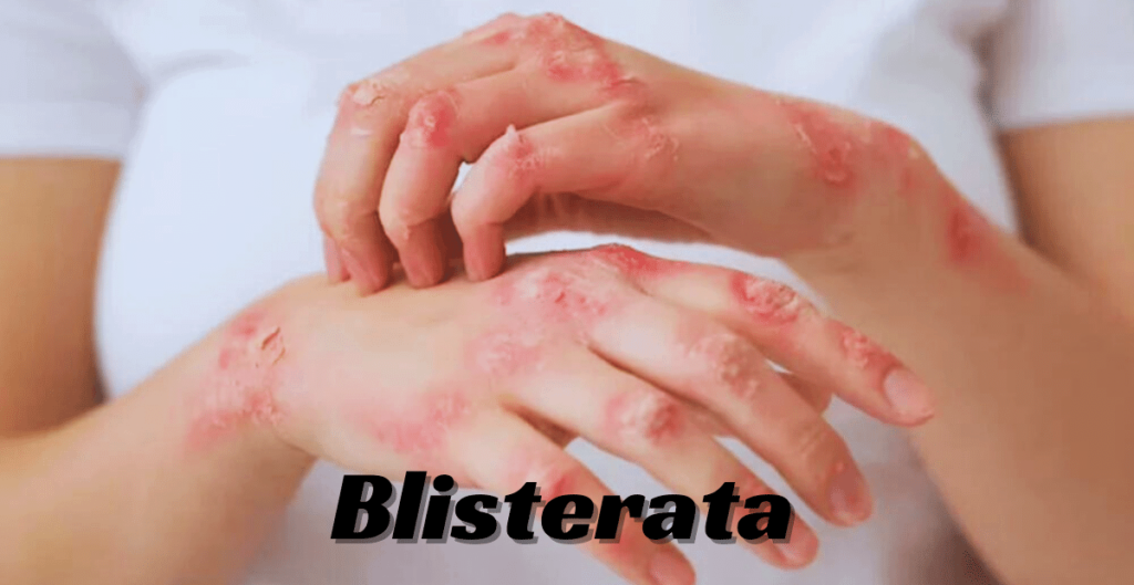 Evolution of Blisterata: Ancient Remedies to Modern Treatments